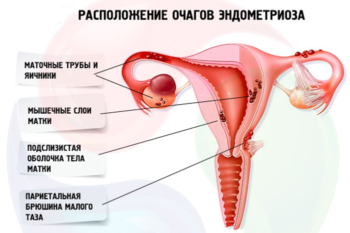 Локализация очагов эндометриоза
