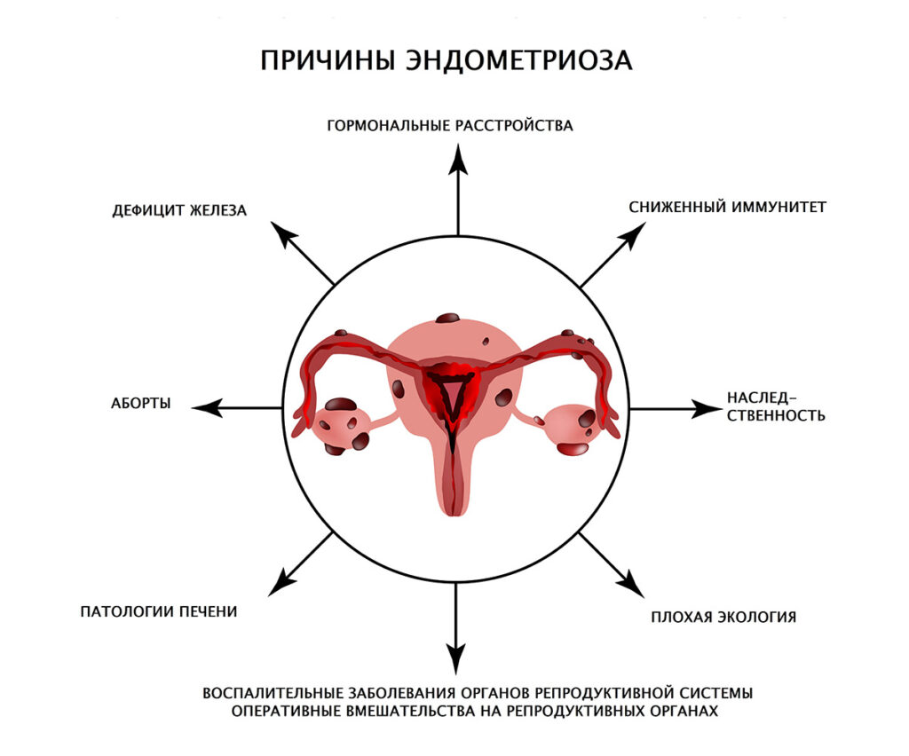 Причины развития эндометриоза